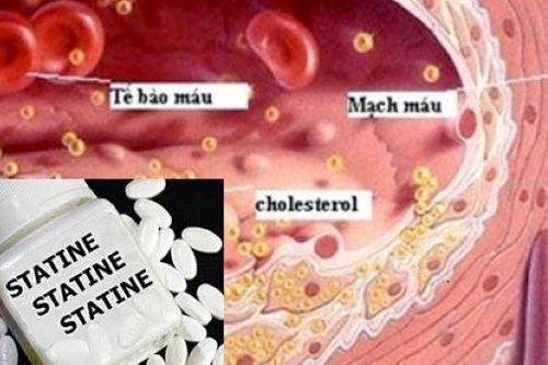 Statin có liên quan đến giảm nguy cơ ung thư đại trực tràng
