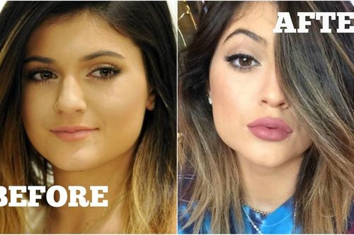 Tại sao mọi người đều tiêm filler làm đầy môi? Những khao khát dấu đằng sau mốt môi dày