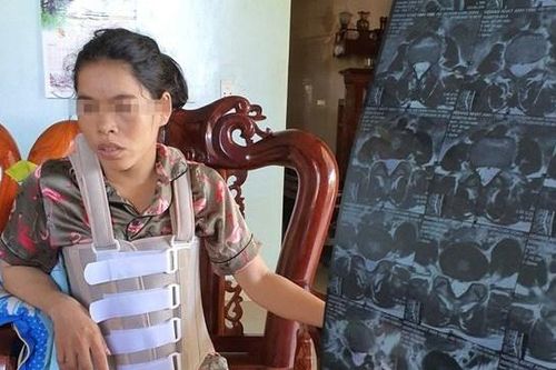 Khởi tố người chồng bạo hành vợ mang thương tật vĩnh viễn 42%
