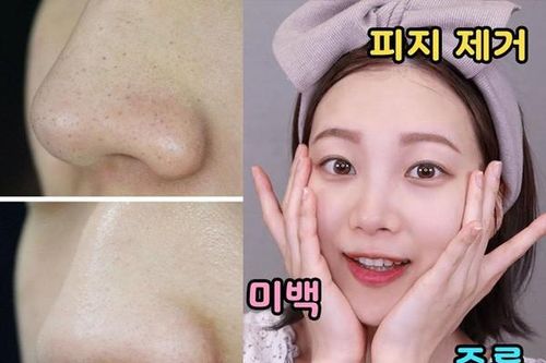 Xử lý mụn đầu đen hiệu quả bằng vaseline và dầu tẩy trang