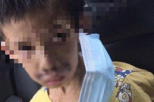 Bé trai 7 tuổi tàn phế vì bị bạo hành: Bố đâm tàn thuốc khắp người, mẹ dùng dao khứa vào chân, hình ảnh nạn nhân gây đau lòng