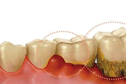 Viêm lợi có gây biến chứng?