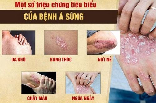 Đối phó với bệnh á sừng