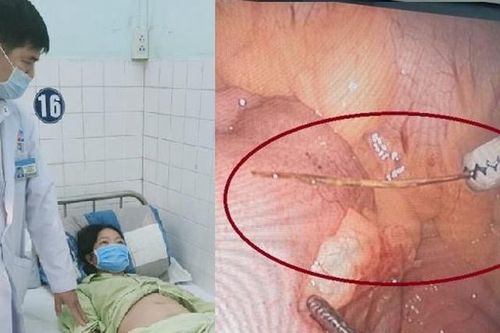 Thói quen nguy hiểm khiến người phụ nữ bị xương cá đâm thủng ruột non
