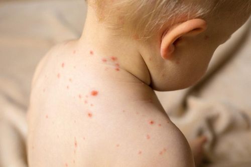 Những điều cha mẹ cần chuẩn bị khi đưa con đi khám sởi