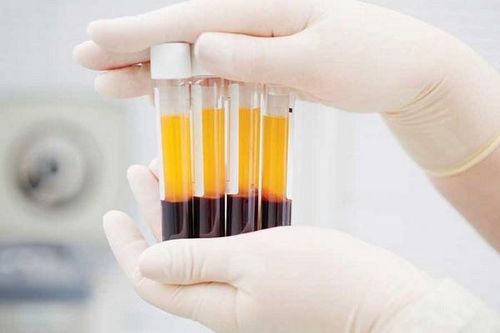 Làm đẹp bằng huyết tương giàu tiểu cầu có an toàn?
