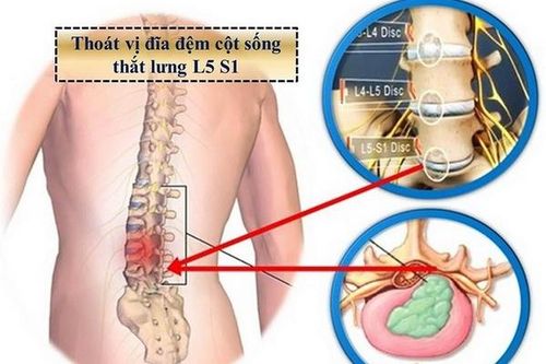 Xoa bóp chữa đau lưng