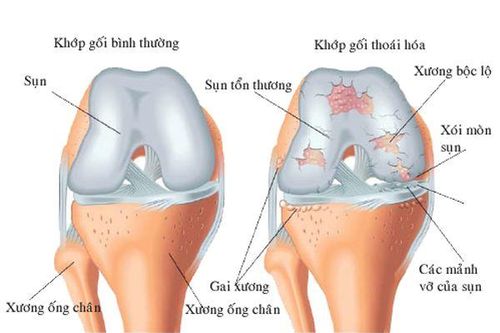 Có thể chẩn đoán thoái hóa khớp trước khi xuất hiện các triệu chứng?