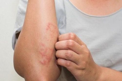 Cách ngừa viêm da cơ địa