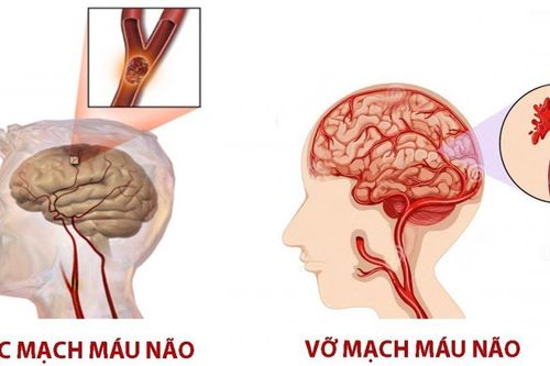 Điều trị tai biến mạch máu não