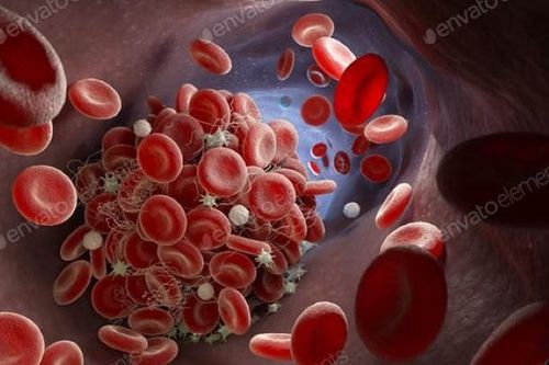 Vì sao máu đông khi nhiễm Covid-19?