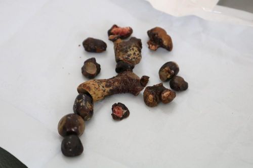 Bác sĩ chườm nước đá lấy sạch sỏi san hô trong thận nam bệnh nhân