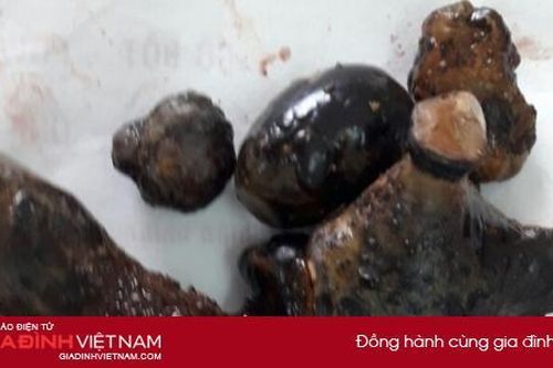 Lấy thành công sỏi san hô như củ gừng cho bệnh nhân sỏi thận