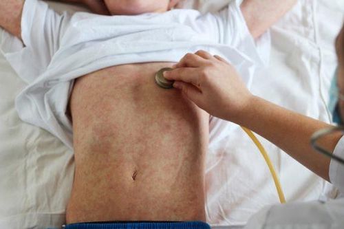 Bệnh sởi: Nguyên nhân và cơ chế lây bệnh