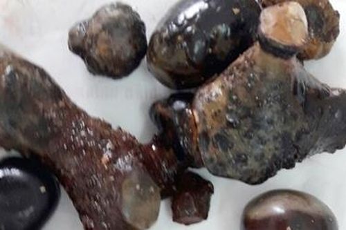 Sốc với 'đống sỏi' trong thận người đàn ông