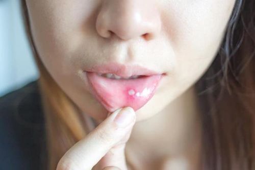 Bạn đã hiểu hết các bệnh viêm loét ở khoang miệng chưa?