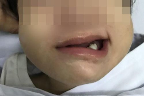 Bé gái 17 tháng tuổi bị méo miệng