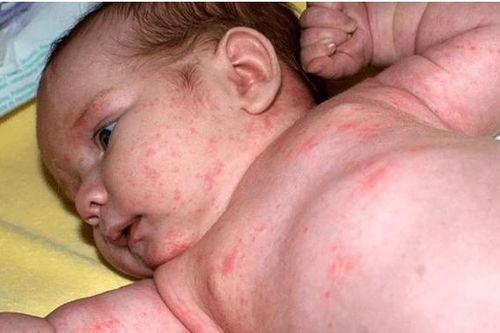 Một số cách điều trị bệnh sởi ở trẻ em an toàn cha mẹ có thể tham khảo