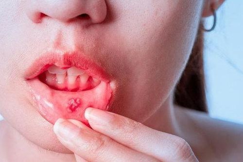 Tiết trời hanh khô, làm sao phòng ngừa viêm loét miệng
