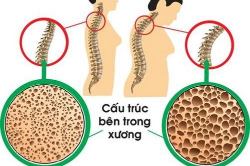 Thuốc trị loãng xương: Sử dụng thế nào cho hiệu quả?