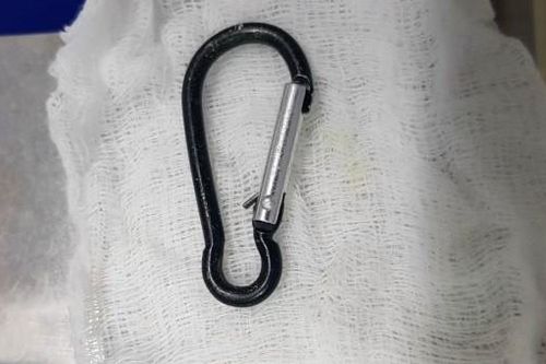 Chiếc móc chìa khóa 'đi lạc' trong dạ dày của bé trai 20 tháng tuổi