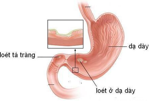 Người viêm loét dạ dày - tá tràng nên ăn thế nào?