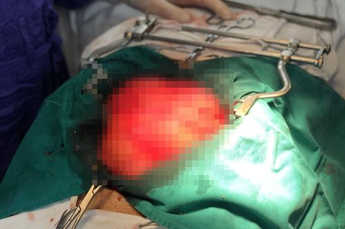 Người đàn ông 2 lần tái phát khối u khổng lồ