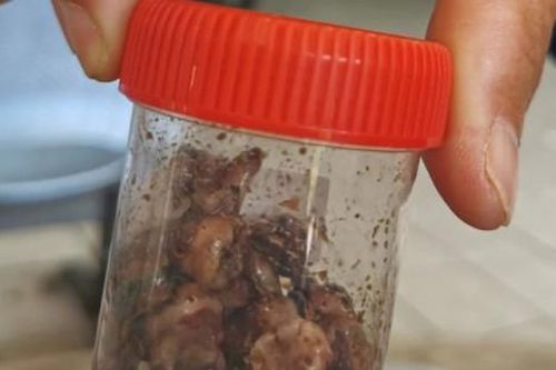 Người phụ nữ mất mạng sau khi nhổ 20 chiếc răng sâu cùng lúc