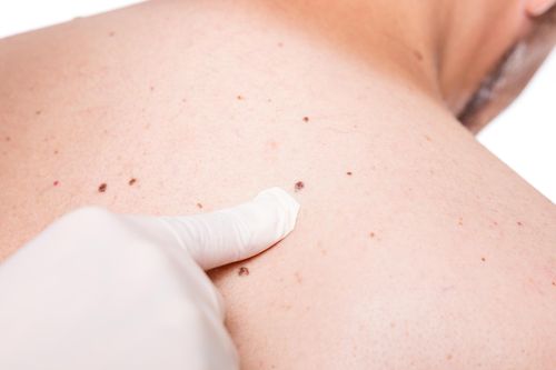 Nốt ruồi cảnh báo ung thư: Phân biệt nốt ruồi ung thư và nốt ruồi thường