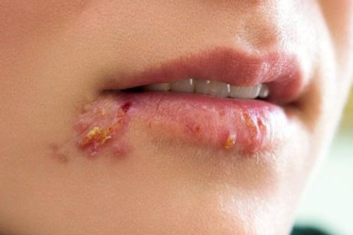 Những biến chứng nguy hiểm của bệnh giời leo