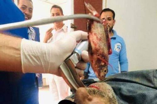 Suýt mất mạng vì bị một con cá sống mắc trong cổ họng