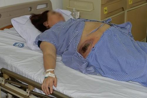 Đắp thuốc lá, nữ bệnh nhân phải cấp cứu vì nhiễm trùng