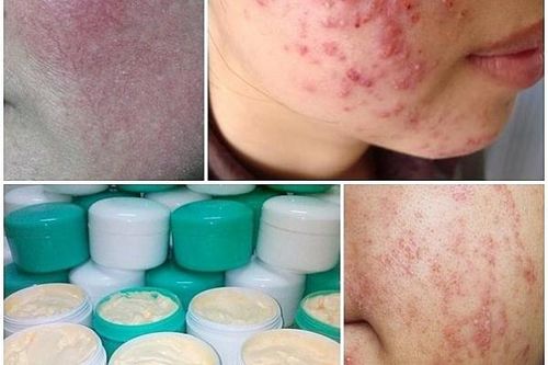Trắng da cấp tốc, tiền mất tật mang