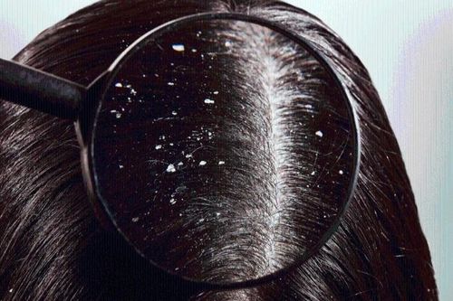 6 cách trị gàu bạn nên thử tại nhà