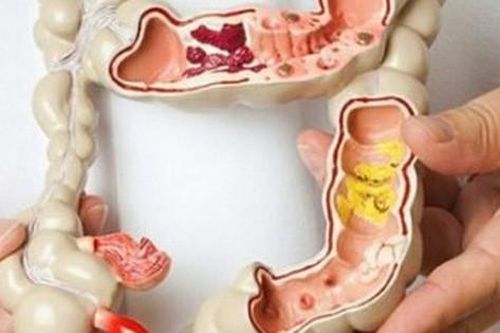 Ung thư đại tràng là ung thư phổ biến hàng thứ 5, hãy ăn loại quả này mỗi ngày để ngăn ngừa nó