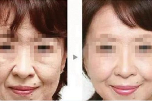 Xóa 'rãnh' trên mặt