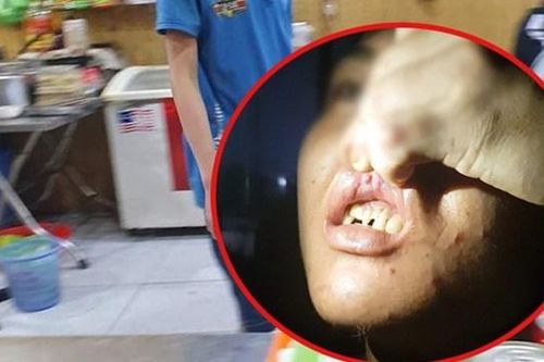 Nhân viên quán bánh xèo bị chủ tra tấn bằng chầy sắt, bàn chông đinh