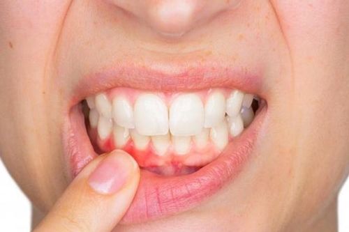 Biết những tác hại kinh hoàng này, liệu bạn còn lười đánh răng buổi sáng?