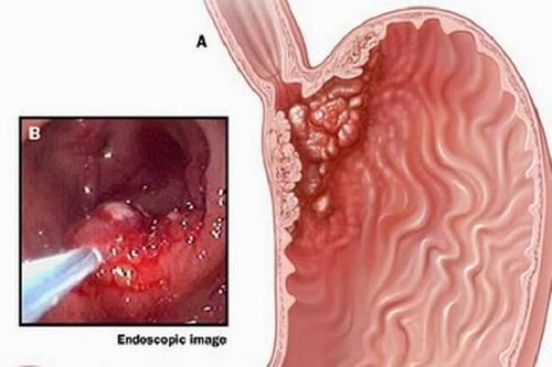Dấu hiệu ung thư dạ dày giai đoạn sớm