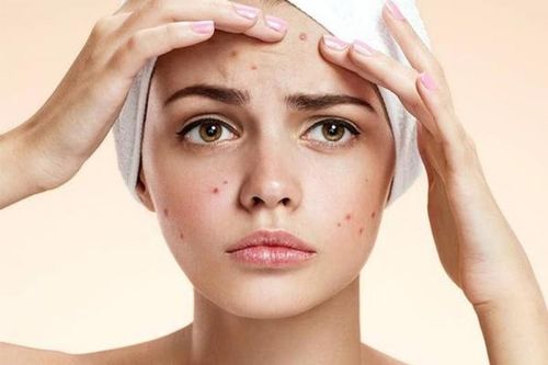Cách đẩy lùi mụn phù hợp cho mọi loại da