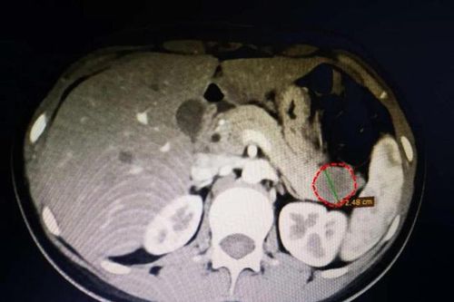 Bé gái 13 tuổi đau bụng, cứ nghĩ do mới có kinh nguyệt nhưng không ngờ là bị 'khối u con gái', bác sĩ nhắc nhở việc cần chú ý để sớm phát hiện ra bệnh