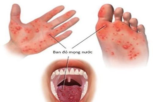 3 dấu hiệu cảnh báo bệnh tay chân miệng ở giai đoạn nặng
