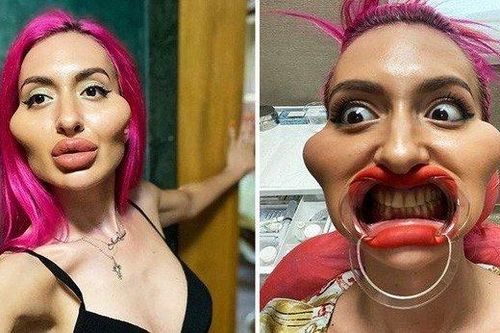 Ngỡ ngàng với ảnh trước đây của mẫu nữ có 'cặp má lớn nhất thế giới'