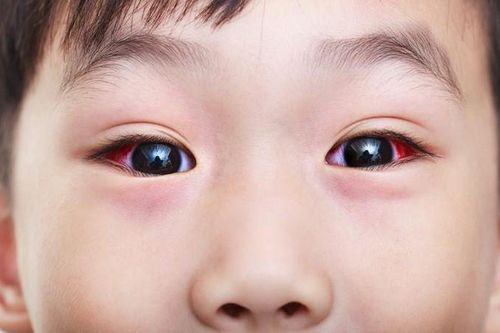 Đau mắt đỏ nên ăn gì? Những thực phẩm tốt cho những người bị đau mắt đỏ