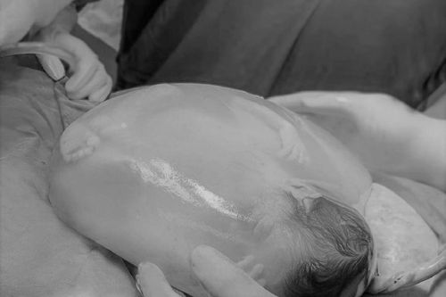Hà Nội: Bé gái song sinh chào đời còn nguyên trong bọc ối