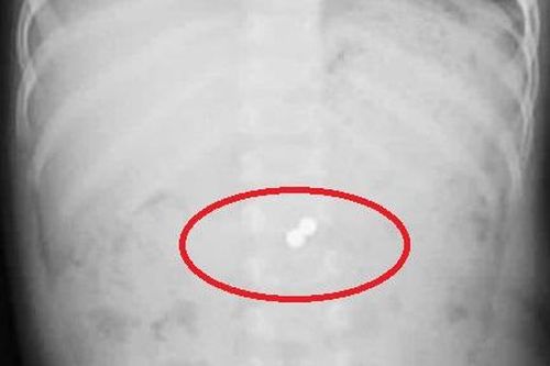 Hai viên bi nam châm bám chặt trong ruột bé trai hơn 6 tháng