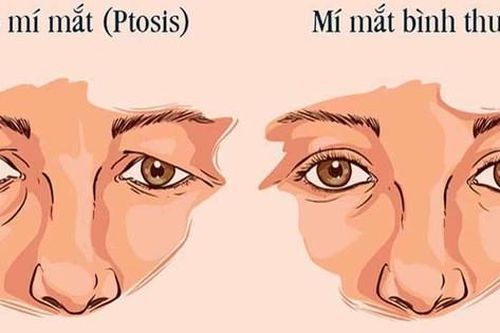 Điều trị sụp mí bằng Đông y – trẻ hóa cơ mắt, cải thiện tầm nhìn