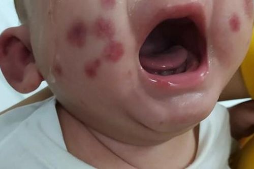 Điều trị thành công ca bệnh chưa từng có tại Việt Nam