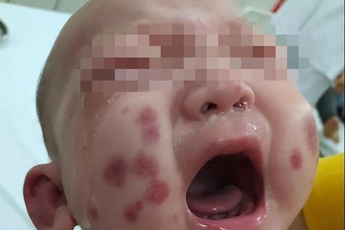 Bé trai mắc bệnh hiếm, lần đầu ghi nhận ở Việt Nam