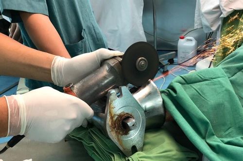 Nhân viên bếp ăn bị máy xay thịt nghiền nát bàn tay